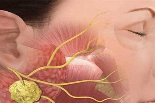 Dấu hiệu nhận biết sớm ung thư vòm họng