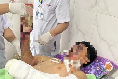 Cảnh báo trẻ bị đa chấn thương do pháo nổ