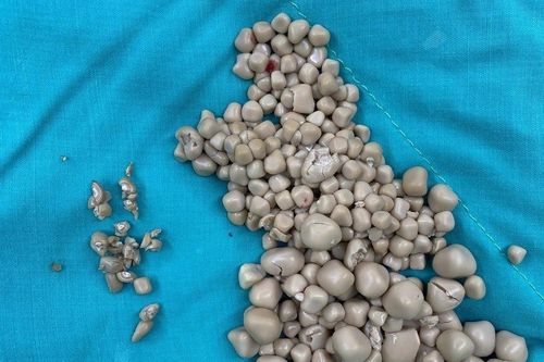 Lười uống nước, cô gái trẻ 'mọc' 300 viên sỏi cứng trong thận
