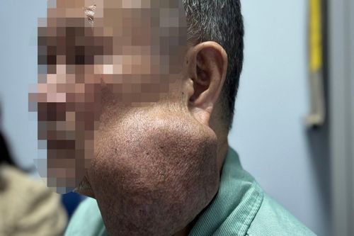 Có u khổng lồ dưới hàm 30 năm không điều trị, người đàn ông suýt bị đe dọa tính mạng