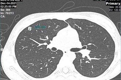 Khoảng trống lớn trong điều trị ung thư xương và phần mềm