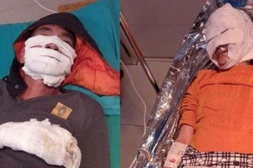 Dùng điện thoại theo cách nhiều người Việt hay làm, hai vợ chồng bị bỏng nặng