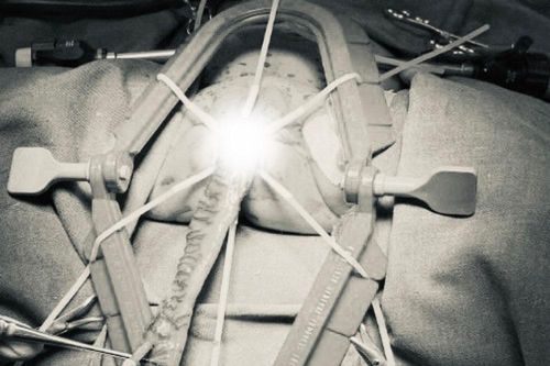 Bệnh nhi 25 ngày tuổi được phẫu thuật nội soi cắt phình đại tràng bẩm sinh