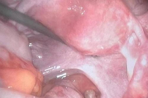 Người phụ nữ 48 tuổi ở Hà Nội chửa ngoài tử cung vô cùng hiếm gặp