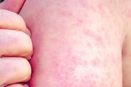 WHO cảnh báo sự gia tăng số ca mắc sởi ở châu Âu