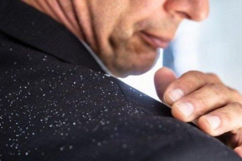 Bí quyết giúp chàng trị gàu nhanh chóng tút lại vẻ bảnh bao đón Tết
