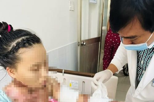 2 chị em ruột bị bỏng cồn trong lúc nướng mực