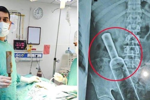Đau bụng đi khám, bác sĩ sốc nặng khi chụp X-quang cho người đàn ông