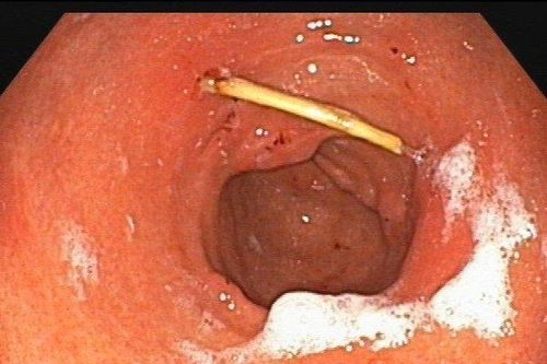 Nội soi gắp que tăm dài 3cm trong thành dạ dày của người đàn ông