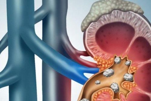 Chế độ ăn uống hợp lý cho người đang mắc sỏi thận