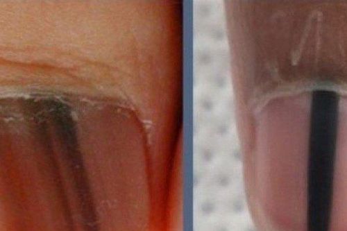 Móng tay có sọc đen có phải ung thư hắc tố?