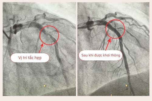 Ngỡ ngàng phát hiện hẹp nặng động mạch vành khi vào viện điều trị cúm