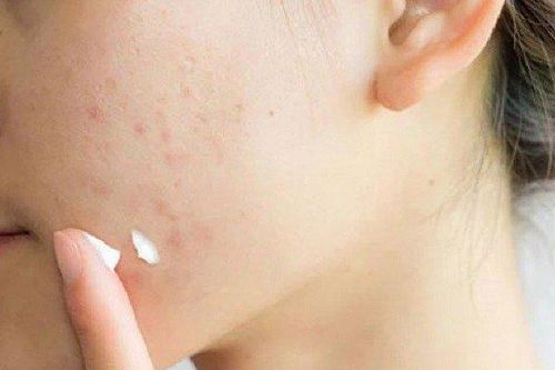Phát hiện chất gây ung thư trong một số sản phẩm trị mụn