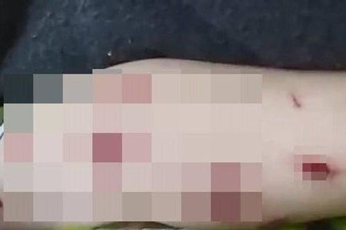 Bé trai 4 tuổi bị thương khi nhặt vật lạ ở sân nhà
