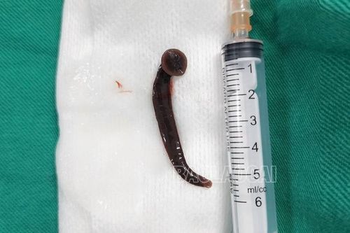 Đỉa sống dài hơn 5 cm nằm trong khí quản bệnh nhân 65 tuổi
