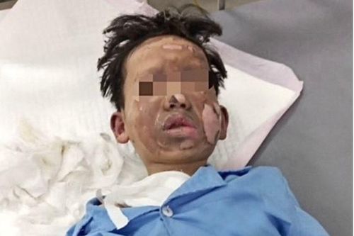 Bé trai bị bỏng nặng do máy tính phát nổ