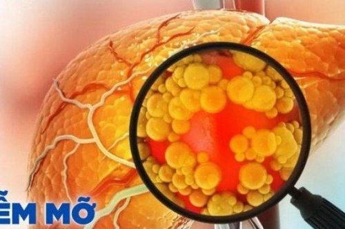 Những loại gan nhiễm mỡ không phải ai cũng biết