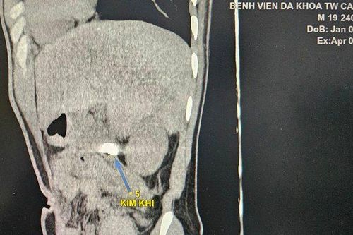 Hy hữu mắt xích máy cưa nằm trong ổ bụng bệnh nhân hơn 2 tuần