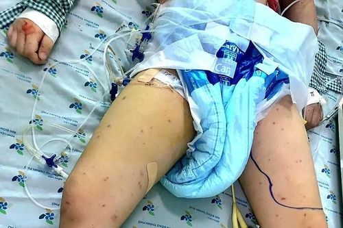 Bé gái 5 tuổi nguy kịch do nhiễm vi khuẩn não mô cầu