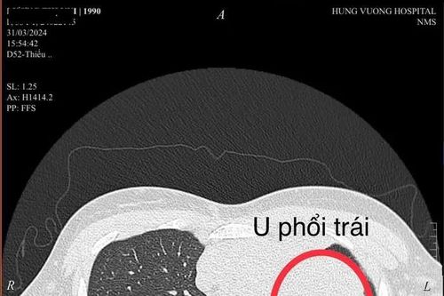 Ung thư phổi ngày càng trẻ hóa