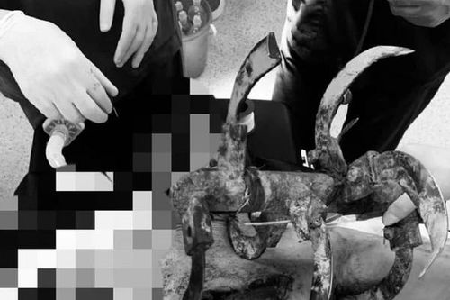Bản tin 15/4: Hy hữu người đàn ông nhập viện với lưỡi cày cắm sâu vào ngực