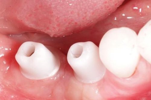 Trồng răng implant DCT - Giải pháp ăn nhai bền vững cho người mất răng