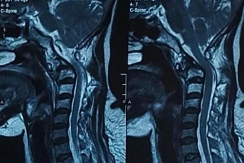 Bệnh nhân ung thư phổi di căn thoát liệt nhờ bác sĩ quyết thực hiện ca phẫu thuật khó
