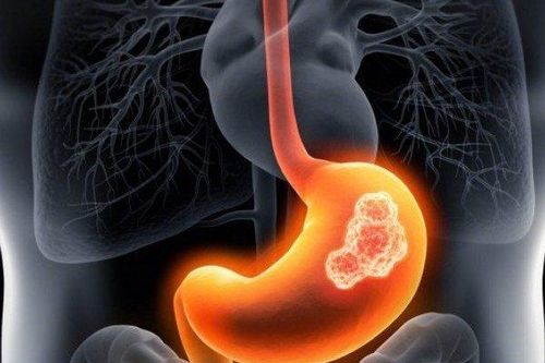 Một hiểu lầm về ung thư dạ dày mà nhiều người trẻ tin sái cổ