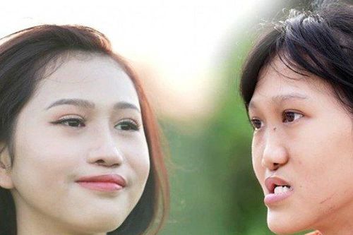 'Cô bé đeo vương miện sắt' lột xác ngỡ ngàng khiến người thân không nhận ra
