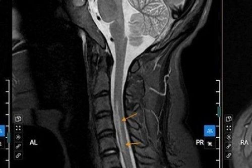 Bản tin 25/4: Thường xuyên tắm muộn, nữ sinh 20 tuổi bị liệt tay