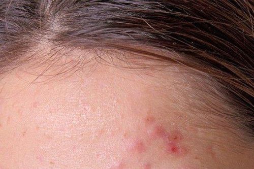 Làm thế nào để chăm sóc da dầu mụn nhạy cảm?
