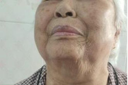 Bà cụ 95 tuổi bị khối bướu chèn ép khí quản