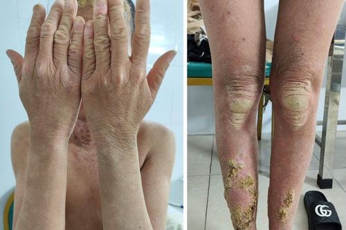 Hiếm gặp: Người phụ nữ mắc bệnh khắp người như mọc 'rêu', thế giới mới có khoảng 100 ca