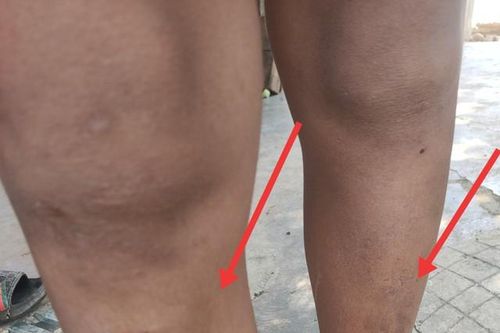 Công an vào cuộc vụ 5 cháu nhỏ bị đánh bầm dập