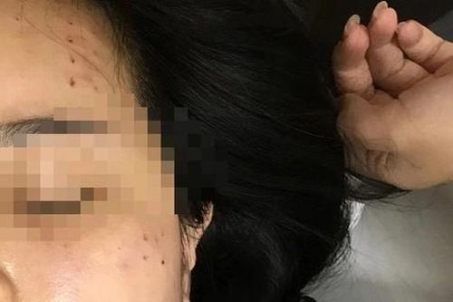 Tiêm nhầm sữa rửa mặt vào da: Thế nào là thẩm mỹ an toàn?