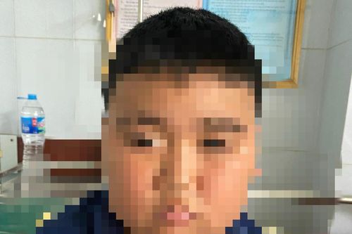 Dùng thuốc quá liều, bé trai 13 tuổi suy thượng thận