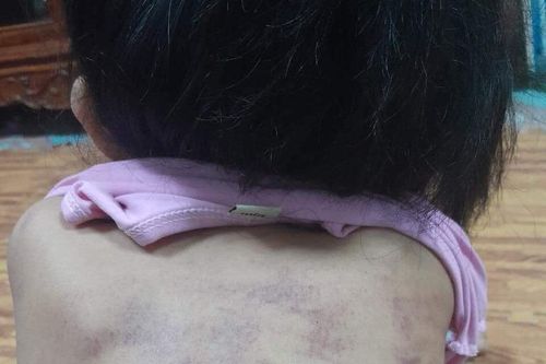 Bé 5 tuổi tím bầm lưng: Phân công 3 giáo viên phụ trách lớp làm nhiệm vụ khác