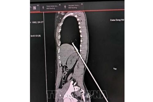 Cứu nam thanh niên bị mũi tên đâm xuyên phổi khi đi bắt cá