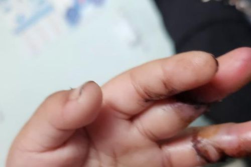 Nối thành công ngón tay đứt lìa cho bệnh nhi 3 tuổi bị quạt chém