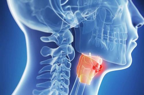 Bị khàn tiếng kéo dài 3 tháng, người đàn ông ở Hà Nội được chẩn đoán ung thư thanh quản