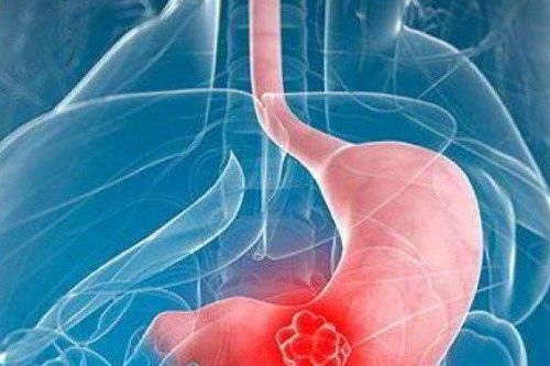 Nhận biết 5 loại ung thư hệ tiêu hóa nguy hiểm và cách phòng ngừa