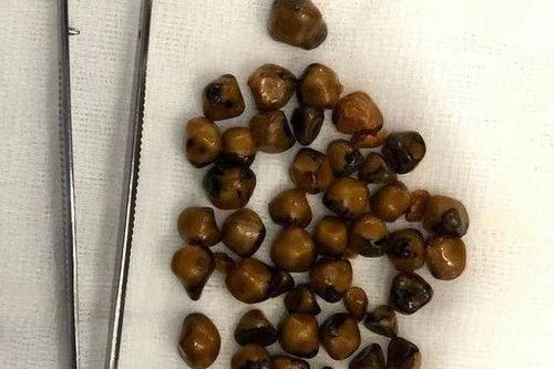 Người phụ nữ 51 tuổi có hơn 40 viên sỏi trong túi mật