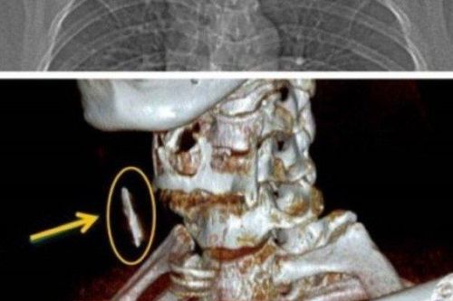 Hy hữu: Người đàn ông bị đinh sắt bắn vào cổ 15 năm mà không biết