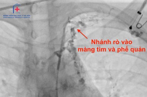 Đau tức ngực, bệnh nhân đi khám phát hiện bị viêm phế quản 'nhựa' thể hiếm gặp