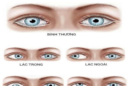 Phẫu thuật lác mắt - Giải pháp mang lại sự tự tin cho người bệnh