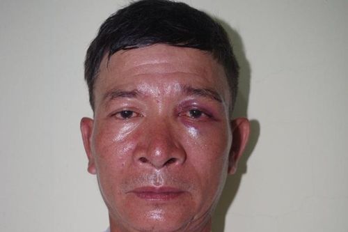 Giả là nạn nhân bị tai nạn giao thông để chiếm đoạt xe máy
