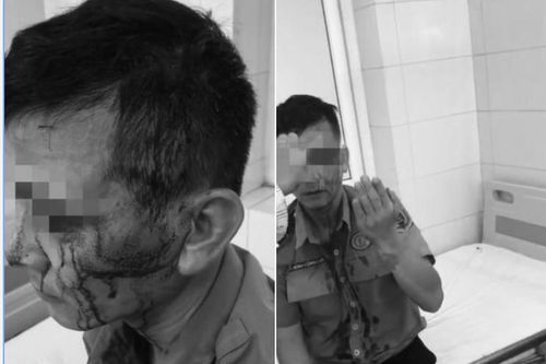 Nhân viên bảo vệ Bệnh viện K bị đối tượng chèo kéo người bệnh hành hung, khâu 8 mũi