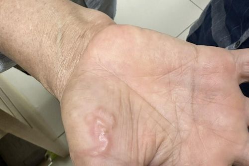 Một phụ nữ có ấu trùng giun đũa bò khắp cơ thể do nuôi 8 con chó, mèo