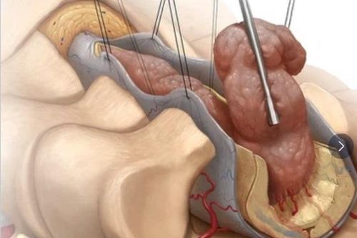 Mất cảm giác ở chân sau khi tập thể dục, cô gái 26 tuổi bất ngờ phát hiện khối u tủy sống