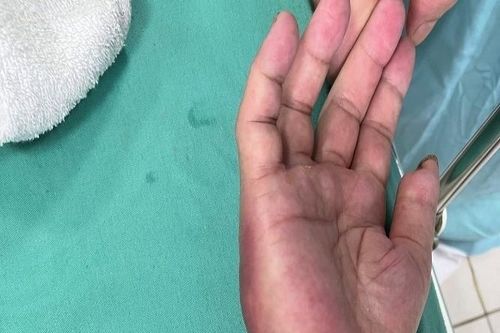Phát hiện 2 ca nhiễm 'vi khuẩn ăn thịt người' ở Hòa Bình